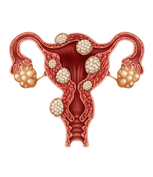 Uterine Fibroids