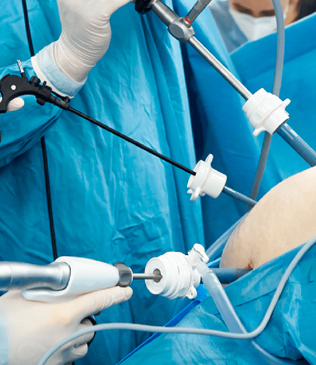 Laparoscopic Surgeries