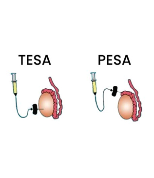 PESA / TESA