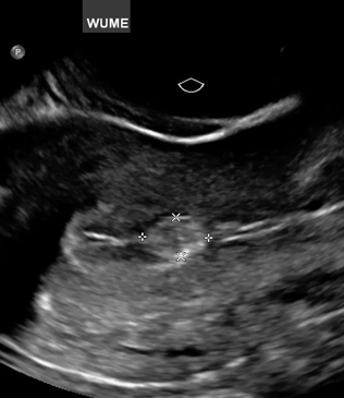 Gynecology Ultrasound